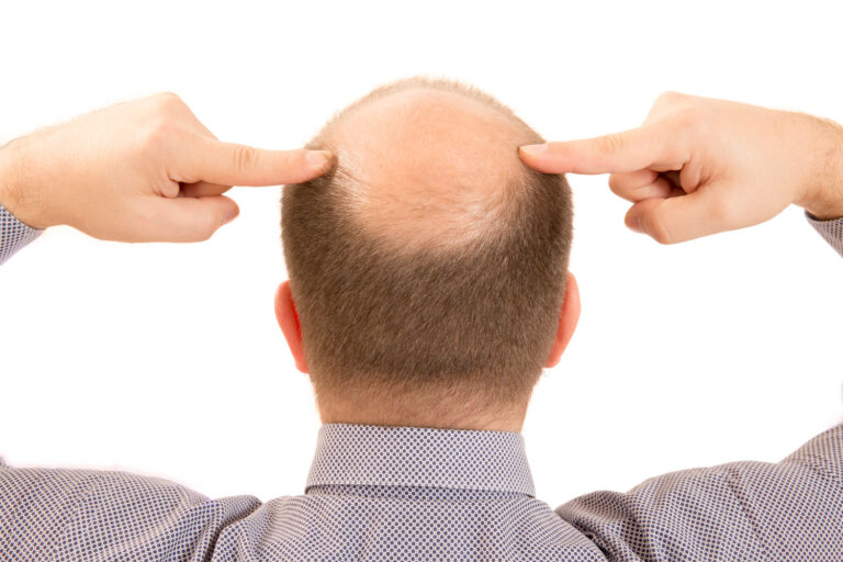 Finasterida: o tratamento para calvície que pode custar sua saúde mental