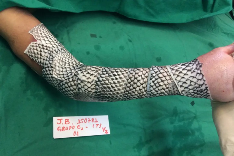 Curativos biológicos feitos com pele de tilápia?