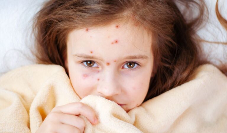 Vírus da Catapora pode aumentar o risco de demência?