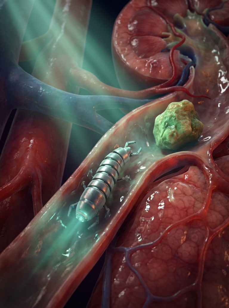 Cientistas criam minirrobô capaz de entrar no corpo e remover pedras nos rins