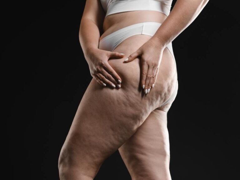 5 razões pelas quais o tratamento moderno do lipedema vai muito além da cirurgia