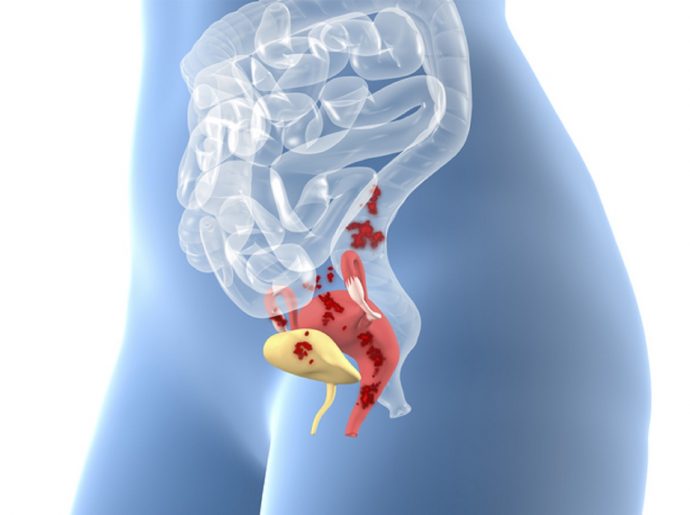 A FDA autorizou um tratamento que ataca lesões de endometriose enquanto preserva a fertilidade