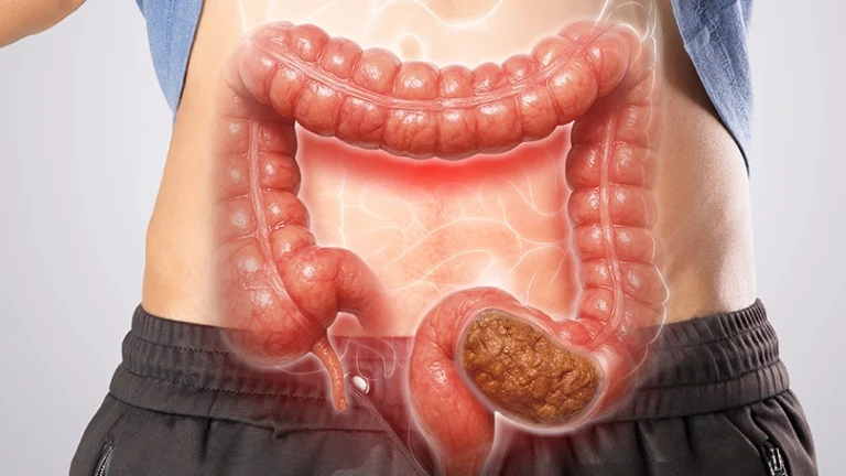 Câncer de intestino já é o 3º mais comum no Brasil
